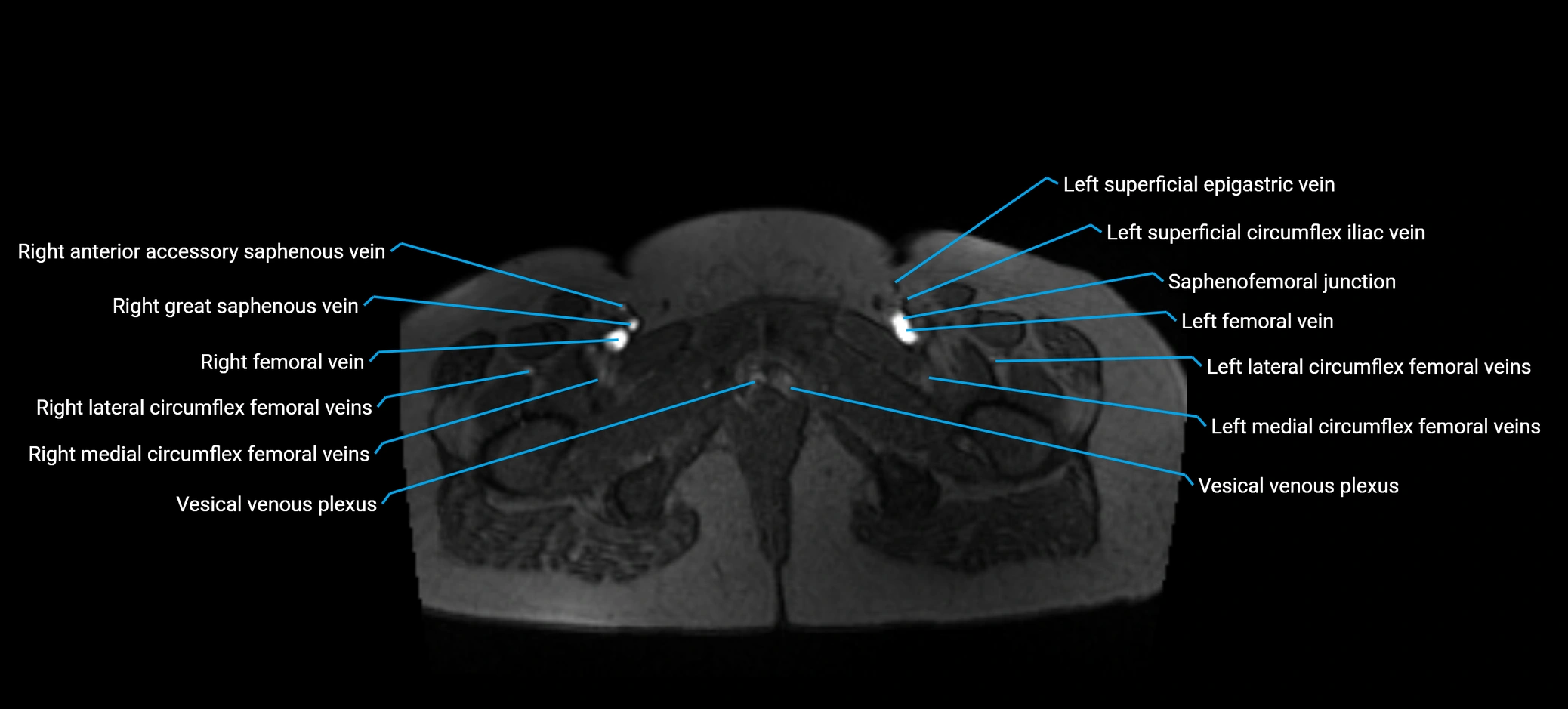 MRV abdomen pelvis & lower limb axial cross sectional anatomy labelled MRI image 195 (1).webp